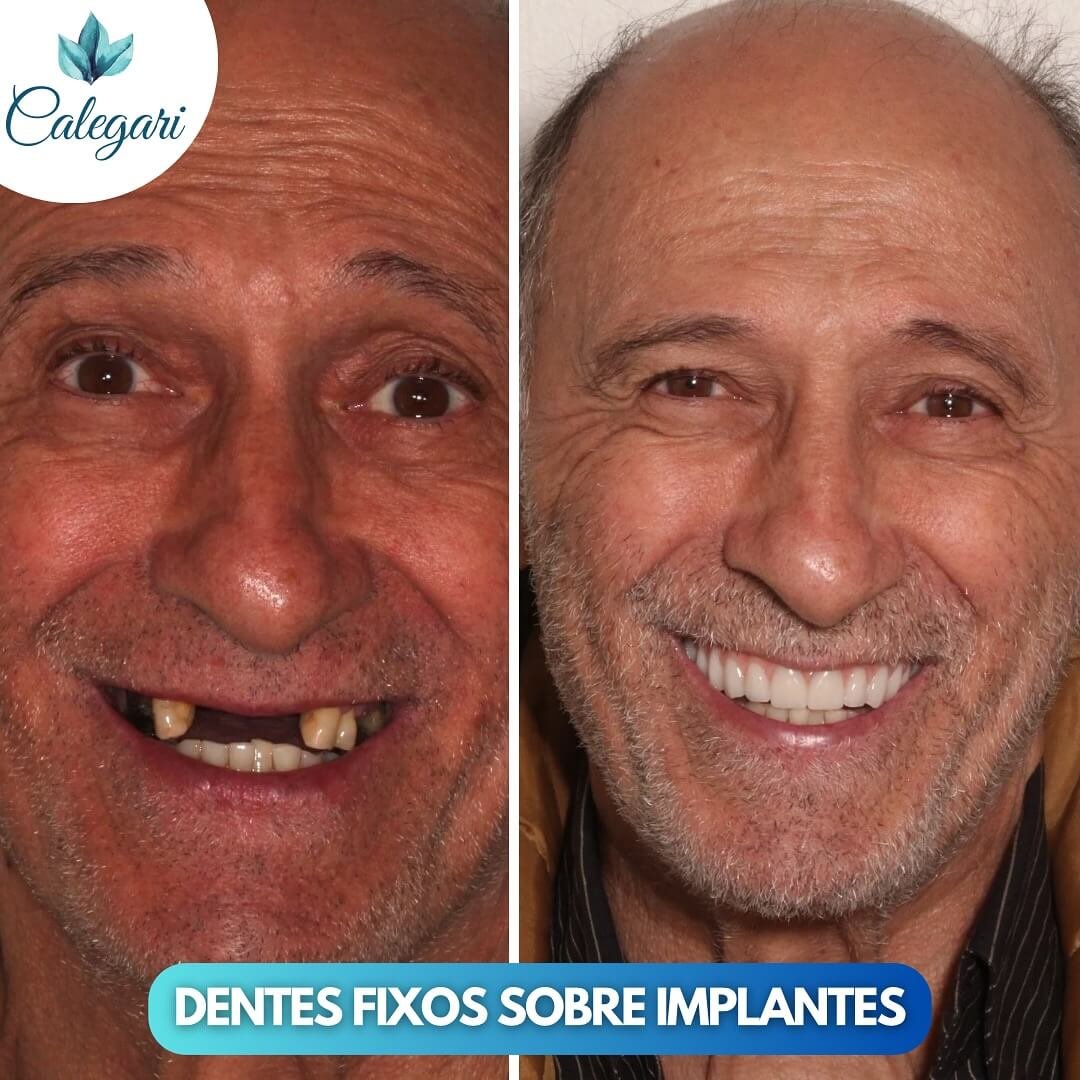 Mais um caso incrivel 💙Concluimos mais um caso de Protocolo dentes fixos sobre implante Des